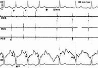 Image result for Permanent Junction Al Reciprocating Tachycardia