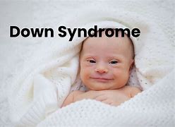 Image result for Severe Down Syndrome