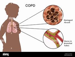 Image result for Peep COPD