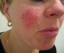 Image result for Killing Demodex Mites On Face