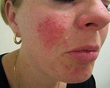 Image result for Demodex Mite Face Rash