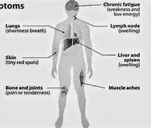 Image result for Hodgkin Lymphoma Cancer Symptoms