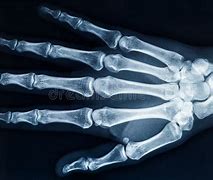 Image result for Bone Age Hand X-ray