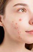 Image result for People with Pimples