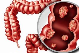 Image result for Cancer De Colon Tac