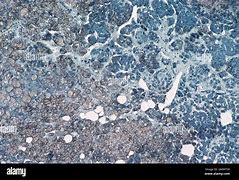 Image result for Adrenal Gland Adenoma