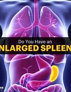 Image result for Spleen Disease Symptoms