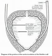 Image result for Long Tunnel Ureter