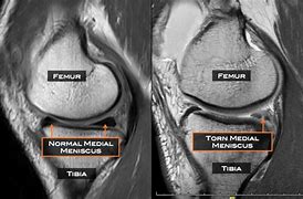 Image result for Knee Meniscus Location