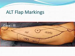 Image result for Anterolateral Thigh Flap