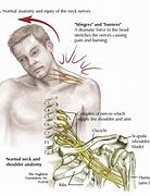 Image result for Brachial Plexus Nerve Glides