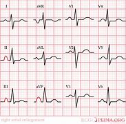 Image result for Heart Failure Electrocardiogram