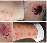 Image result for Bed Bug Bites Row