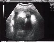 Image result for Head Circumference 37 Weeks Ultrasound