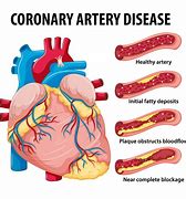 Image result for Coronary Artery Disease