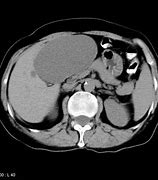 Image result for Complex Liver Cyst