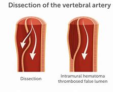 Image result for Vertebral Dissection On Angiogram