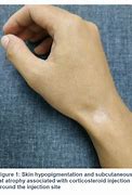 Image result for Sclerotic Atrophy of Skin