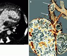 Image result for Anatomical Site of Left Ventricular Outflow Tract