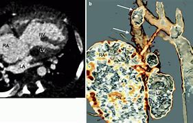 Image result for Left Ventricular Outflow Tract Stroke Volume