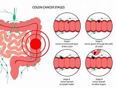 Image result for Cancer De Colon Tac