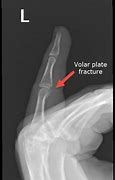 Image result for Volar Fracture