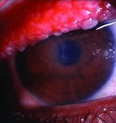 Image result for Tarsal Conjunctiva Papillae