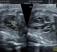 Image result for Rvot and LVOT Fetal Ultrasound Images Colour