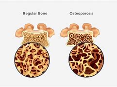 Image result for Osteoporosis Lumbar Spine