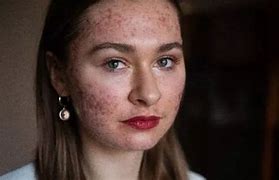 Image result for Bad Skin Face