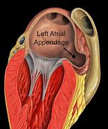 Image result for Atrleft Atrail Appendage Thrombus