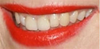 Image result for Naomi Watts Teeth