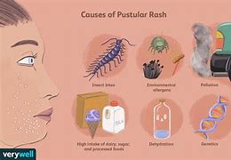 Image result for Pustular Skin