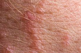 Image result for Poison Ivy Oak Sumac Rash