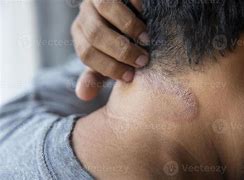 Image result for Eczema On Darker Skin