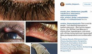 Image result for Eyelash Mite Removal