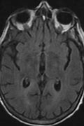 Image result for Hepatic Encephalopathy MRI