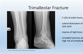 Image result for ICF Model Trimalleolar Fracture