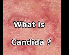 Image result for Candida Skin Rash Symptoms