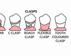 Image result for Partial Denture Clasps