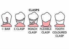 Image result for partial denture clasps materials