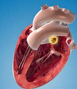 Image result for What Is a Thrombus