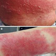 Image result for What Are Pustules On the Skin