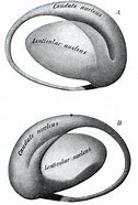 Image result for CT Brain Lentiform Nucleus