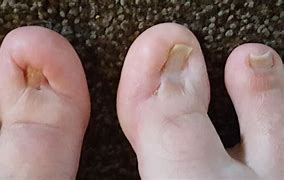 Image result for Pedicure for Ingrown Toenail