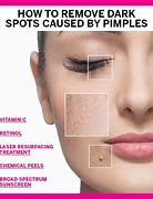 Image result for Pimple Black Spot