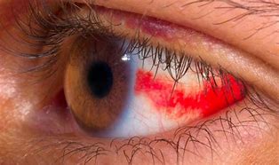 Image result for High Blood Pressure Eye Symptoms