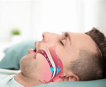 Image result for Obstructive Sleep Apnea Mouthpiece