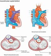 Image result for Complete Atrioventricular Canal Defect