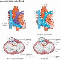 Image result for Atrioventricular Canal Defect Osmosis